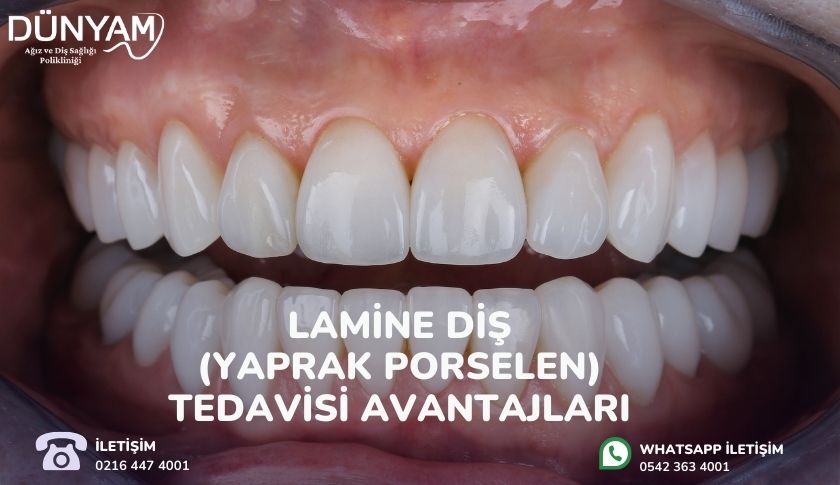 Lamine Diş Tedavisi Avantajları